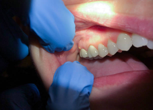 Best Knocked-Out Tooth Emergency  in Belvidere, NJ